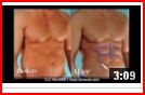 Houston Texas Abdominal Etching Cosmetic surgery